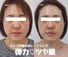 「小顔にもなれてツヤ肌も手に入る✨【 福井 / 福井市 / ハイフ / 韓国 / 小顔 / ポレーション  / ツヤ肌 /  にきび / シミ 】」