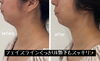 顎下も直後からここまでスッキリ❣️「首まで細く長く😍✨【福井エステ/福井ハイフ/福井小顔/福井メンズフェイシャル】」