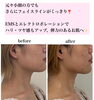 「元々お顔が小さい方でもさらにスッキリ🥹✨【福井ハイフ/福井小顔/福井フェイシャルエステ】」