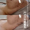 「ハイフでたるみ改善！若返る！【  福井 / エステ / ハイフ / 小顔 / リフトアップ / むくみ解消 / シワ  】」