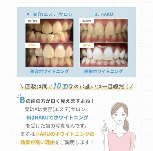 メニューご紹介🌈お試し体験カウンセリング無料💠メディカルホワイトニングHAKU南船橋！ららぽーと東京ベイから徒歩1分🌟船橋競馬場駅から6分🌟  歯科提携の本格セルフホワイトニングで、理想の白さが叶います！ | メディカルホワイトニングHAKU 南船橋店のニュース ...