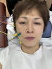 電気の美容鍼「美容鍼×プラズマ最強美肌！」