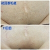 VIO脱毛、10回の効果👍🏻 | 脱毛サロンkohaのニュース