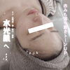 「大人気ハーブピーリングで圧倒的透明感【福井ハーブピーリング/福井エステ/福井肌質改善】」