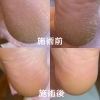 角質ケアですべすべなお肌に「夏も終わり！冬へ向けての角質ケアを♬【松山のフットケアサロンならuta♪看護師による丁寧な施術！巻き爪・足裏の角質・タコ・アロマトリートメントなどあしのことならなんでもお任せください！】」