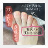 「内反小趾？！【福井市/ネイル/フットケア】」