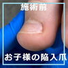 お子様の陥入爪写真４「お子様の陥入爪　No.90」