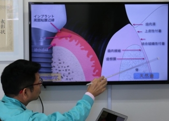 インプラントした状況と天然歯の状況。<br>（骨に直接チタンが埋め込まれる）