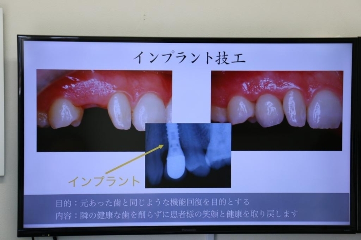 元あった歯と同じような機能を回復し、隣の健康な歯を削らずに患者さまの笑顔と健康を取り戻す。