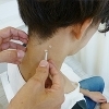 （3）２．鍼灸施術
