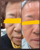 70代の母です！1回の施術でこの変化！「2月末までの期間限定キャンペーンのご案内」