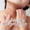 第19回 　ジュクジュクした傷、それって「とびひ」かも？