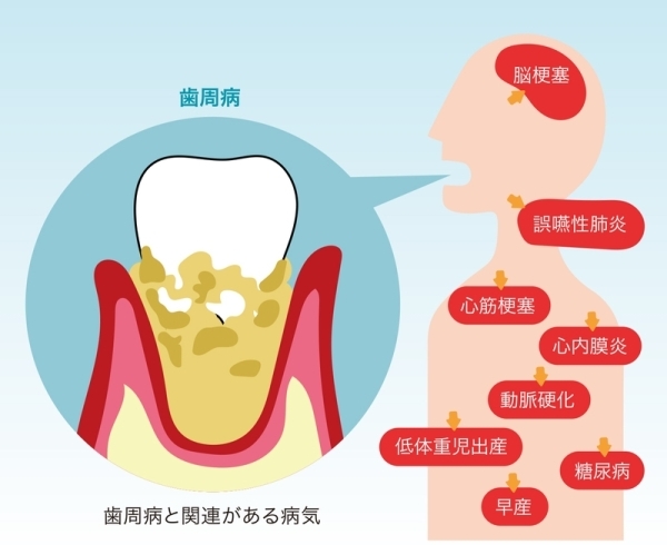 歯周病と関連がある病気…。怖いですよね (^^;)「忘れがちな「歯」。歯（口腔内）について見直しをし、トータルで健康維持しましょう！」