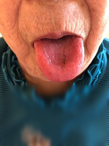 きれいな舌です！「舌をきれいにしていますか？　#舌#ベロが白い#舌の汚れ」