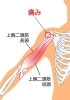 上腕二頭筋の炎症は肩に痛みが出ます。「肩の痛みや違和感は、腕（上腕二頭筋）が原因の事もあるのです。」