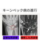 キーンベック病―“治癒が難しい”とされる中でみられた一例「キーンベック病―“治癒が難しい”とされる中でみられた一例」