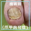 No.61お爪再生コース施術事例３「No.61お爪再生コース（爪甲鉤彎症）の施術事例」