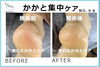 「かかと集中ケア」No.98-3「バキバキのかかと割れをプルプルに「かかと集中ケア」No.98」