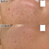 「2種類のハーブでニキビ跡・色素沈着も早期改善【福井ハーブ/福井肌荒れ/福井美肌サロン/福井フェイシャルエステ】」