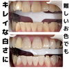 「どんどん白い歯に！劇的変化のメディカルホワイトニング症例」