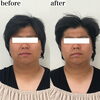 両頬もスッキリしリフトアップ「脂肪分解フェイシャルでメンズも小顔へ【福井脂肪分解/福井ハイフ/福井小顔サロン/福井ハーブピーリング】」