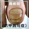 N68.変形爪（爪甲鉤彎症）のケア事例３「N68.変形爪（爪甲鉤彎症）のケア事例」