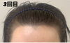 スカルプタトゥー「薄毛ケア」