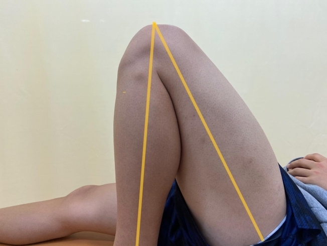 大腿部の打撲 ももかん を早く治す方法 竹崎鍼灸整骨院のニュース まいぷれ 出雲 大腿部の打撲 ももかん を早く治す方法 竹崎鍼灸整骨院のニュース まいぷれ 出雲