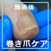No.75巻き爪施術後「No.75 矯正中もキレイな爪」