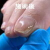 No.51陥入爪「角が痛くて爪が伸ばせない」４「No.51陥入爪「角が痛くて爪が伸ばせない」」
