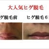 【男性脱毛】ヒゲ脱毛14回コース　96,000円→40,000円