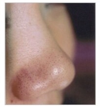 毛穴の黒ずみを自己ケアで改善できた人いるの Esthe Salon Plum エステサロン プラム のニュース まいぷれ 出雲