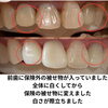 before after「差し歯があっても理想の白さへ！メディカルホワイトニングで自信の笑顔に」