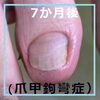 N68.変形爪（爪甲鉤彎症）のケア事例４「N68.変形爪（爪甲鉤彎症）のケア事例」