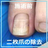 二枚爪のケア　No.97ー３「二枚爪のケア　No.97」
