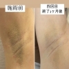 脱毛