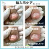 二枚爪の下の爪の「陥入爪ケア」No.100 | 重度の足爪トラブル専門