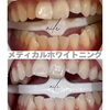 before after「口元は意外と見られてます！白い歯で好印象アップしませんか？」