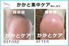 かかと集中ケア５「「夏のサンダル向け」かかと集中ケア　No.92 」