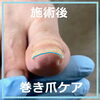グサッとつきささっていた爪の跡4「グサッとつきささっていた爪の跡が！　巻き爪ケア事例No.93」