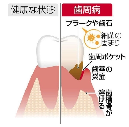 出展  東京新聞「歯周病が全身の病気を引き起こすって本当？  フェアリ歯科です」