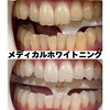 「何年経っても白い歯へ！定着重視のメディカルホワイトニング」