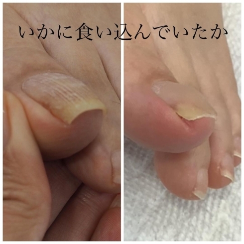 巻き爪改善 足のトラブルもお任せください 福井市 ネイルサロン 巻き爪補正 Nail Melia Medical Healthcare のニュース まいぷれ 福井 巻き爪改善 足のトラブルもお任せください 福井市 ネイルサロン 巻き爪補正 Nail Melia Medical Healthcare のニュース まいぷれ 福井