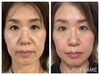1カ月使用。ほうれい線、目の下、ハリ感が違う「話題のヒト幹細胞培養液を贅沢に使用★若返りフェイシャル」