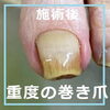 No.72ストロー重度の巻き爪施術事例４「No.72ストロー重度の巻き爪」