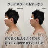 「男性もハイフで理想のフェイスラインへ【福井市エステ/福井市ハイフ/福井フェイスエステ/福井メンズフェイシャルエステ】」