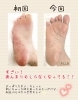 その後の経過は…？「【皮膚むしり症】続編・3ヶ月後の様子♪【フットケア】」