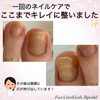 〈after〉透明感も出てスッキリ！「トラブル爪のフットネイルケア①」