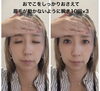 「おでこのシワと目元のたるみが気になる方へ」