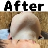 脱毛
